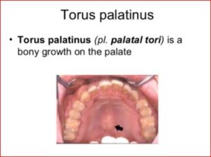 Torus Palatinus Picture 2