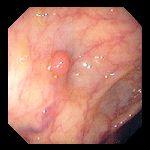 Hyperplastic Polyps picture 1