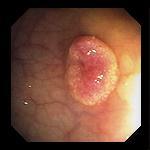 Hyperplastic Polyp Picture 2