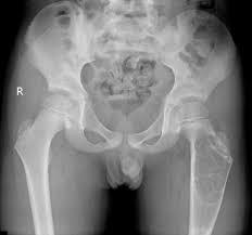 Aneurysmal Bone Cyst Picture 1