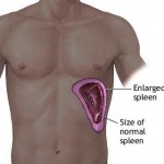 Enlarged spleen Picture 2