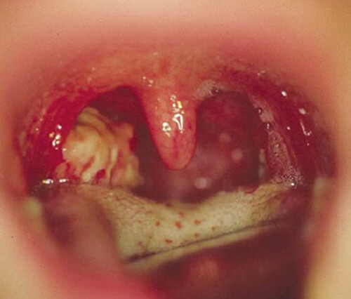 inflammation of lingual tonsils