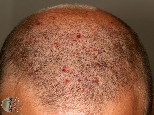 Scalp folliculitis Picture 3