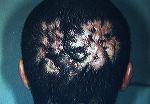 Scalp folliculitis Picture 2