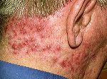 Scalp folliculitis Picture 1