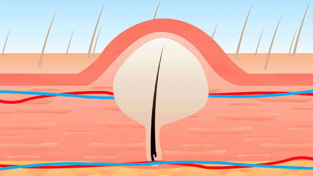 Ingrown Pubic Hair