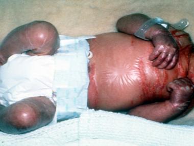 Lamellar Ichthyosis