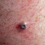 Dilated Pore Of Winer