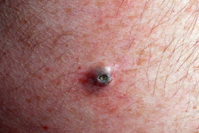 Dilated Pore Of Winer