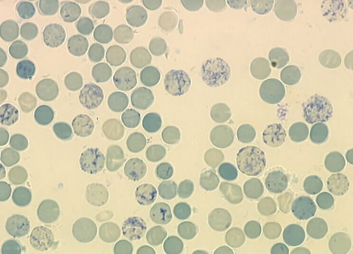 reticulocytes-what-is-high-normal-low-counts-causes-risks