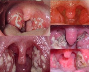 White Spots on Tonsils - Symptoms, Causes, Treatment, Home Remedies