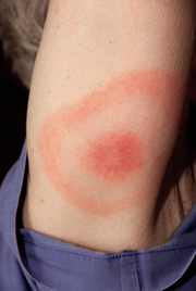 Armpit Rash Image 2