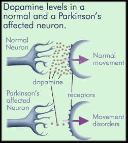 Dopamine levels in a normal neuron and a neuron affected by Parkinson’s disease