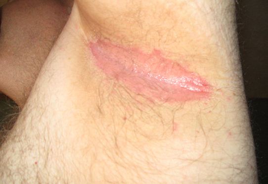 Armpit Rash Image 1