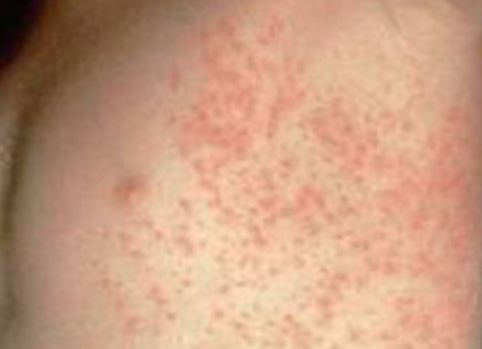 Armpit Rash images