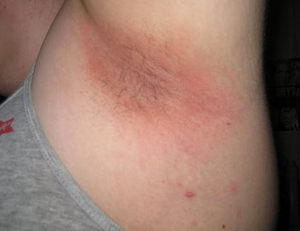 Armpit Rash pics 5