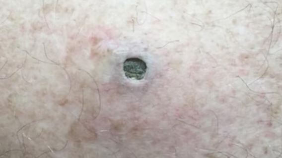 Dilated pore of Winer Images