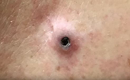 Dilated pore of Winer Pics