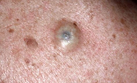 Dilated pore of Winer Pictuures