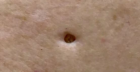 Dilated pore of Winer
