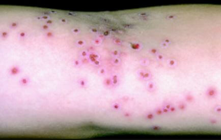 Eczema herpeticum photos
