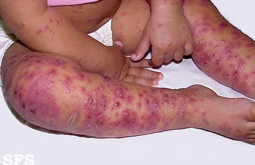 Eczema herpeticum pics 4