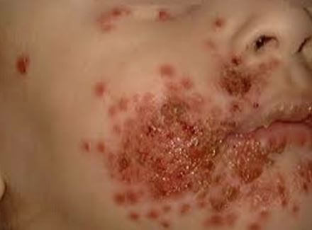 Eczema herpeticum pics