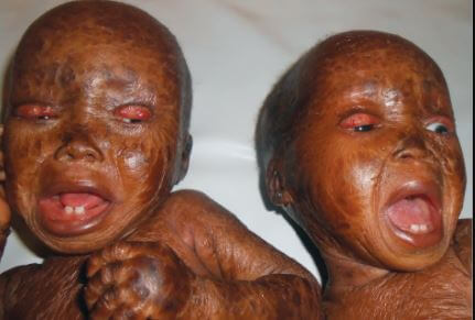 Lamellar Ichthyosis images 6