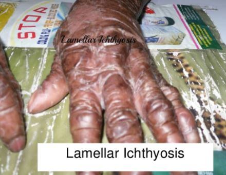 Lamellar Ichthyosis images