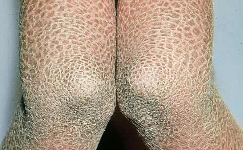 Lamellar Ichthyosis pictures 2