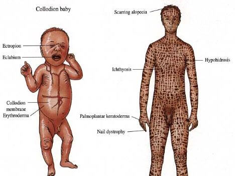 Lamellar Ichthyosis