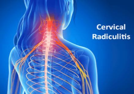 Cervical Radiculitis Images