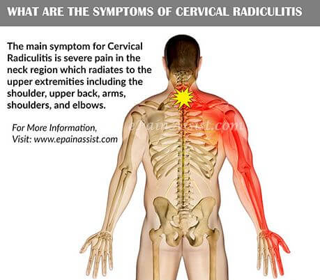 Radiculitis symptoms