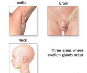 Swollen Lymph Nodes in Axilla, Groin, Neck. 