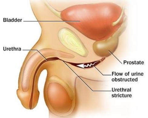 Urethral Stricture