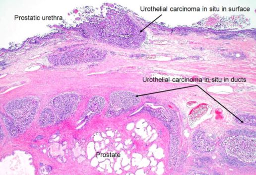 Urothelial carcinoma histology