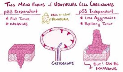 urothelial carcinoma