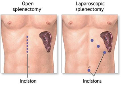 Spleen Surgery Splenectomy incision