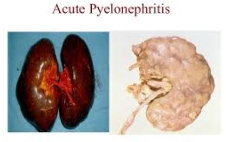 Acute Pyelonephritis
