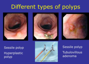 Sessile Polyp Picture 2