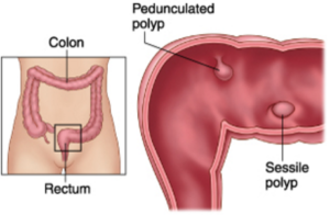 Sessile Polyp Picture 3