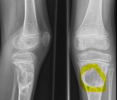 Aneurysmal Bone Cyst