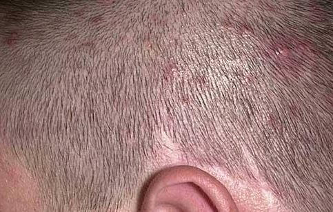 Scalp Folliculitis image