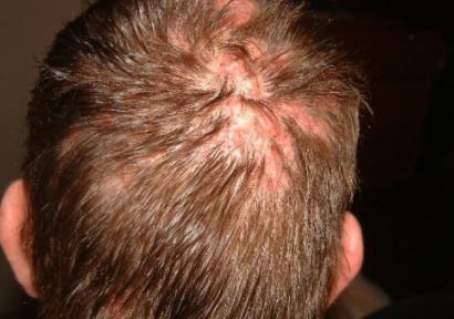 Scalp Folliculitis images